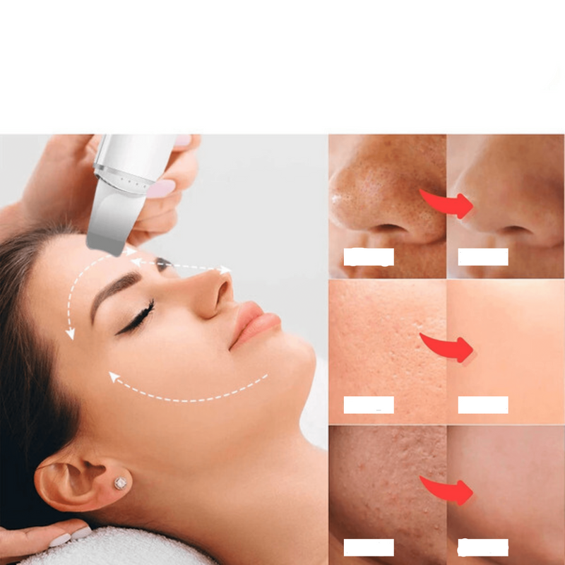 Esfoliador Ultrassônico: Removedor de Cravos e Limpador Facial